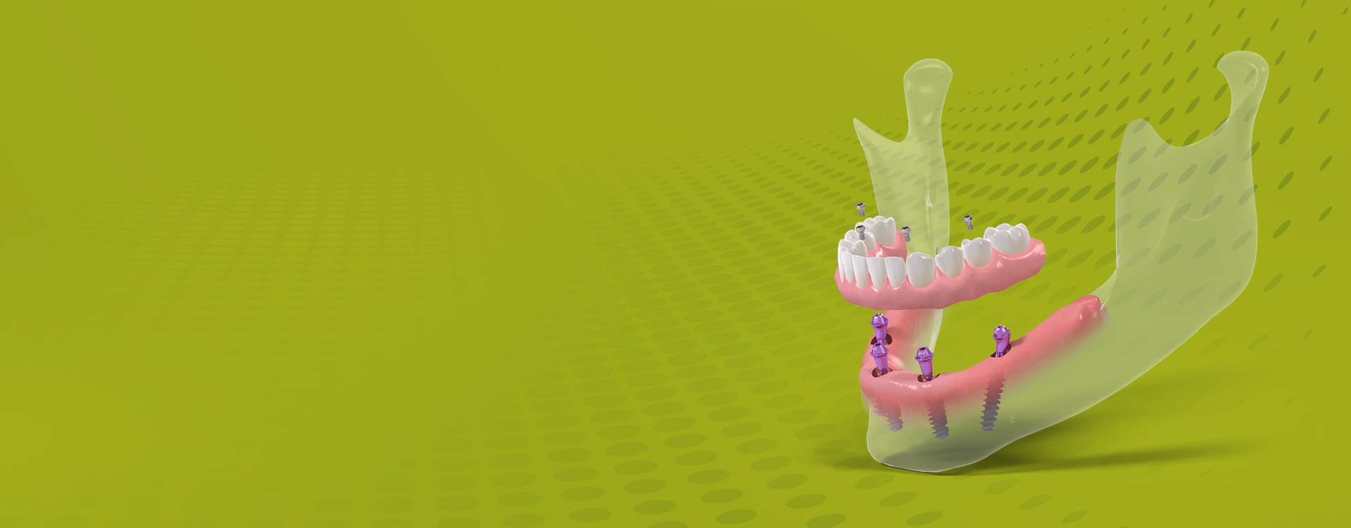 Nowy uśmiech w 1 dzień